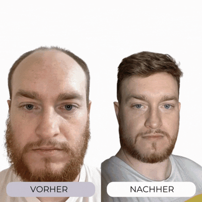 MICRO-INFUSE® Haartechnologie – Für Männer