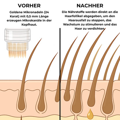 MICRO-INFUSE® Haartechnologie – Für Männer